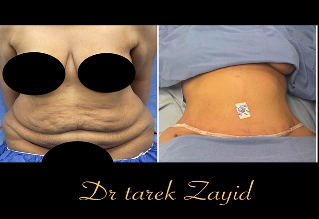 شد الترهلات